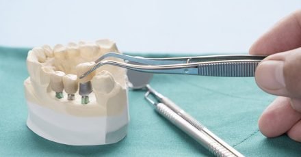 partes de implantes dentales