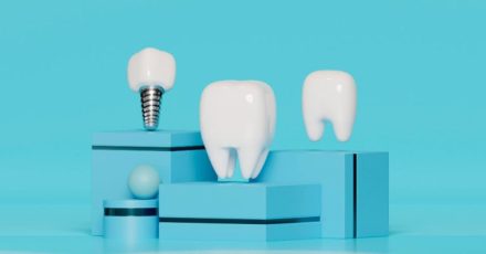 implante-dental