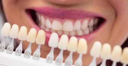 carillas-dentales