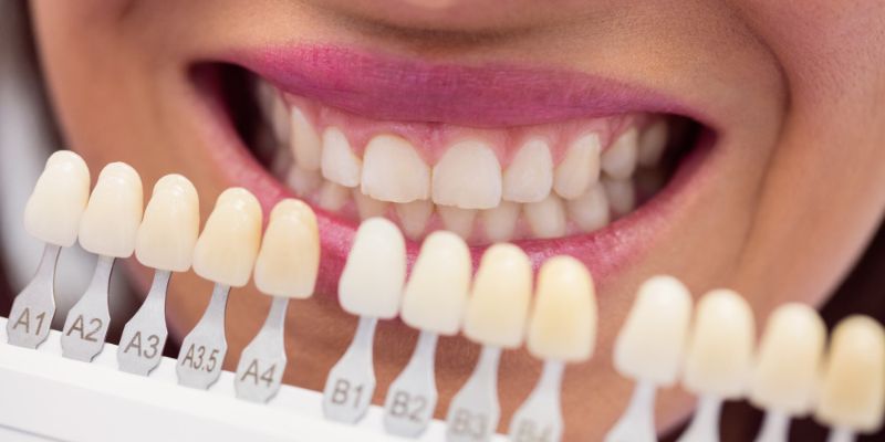 carillas-dentales