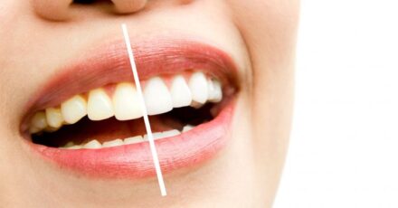 dientes-amarillos