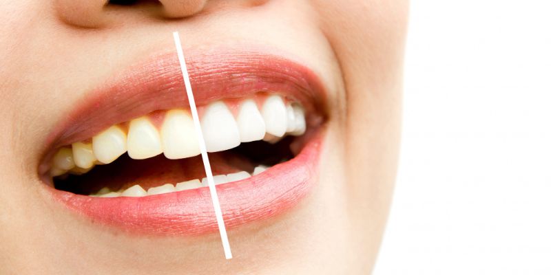 dientes-amarillos