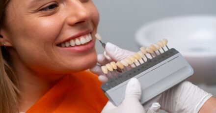 carillas-dentales